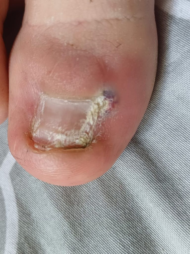 Egzostoza podpaznokciowa palucha powodująca deformację paznokcia i podrażnienie wału paznokciowego.
