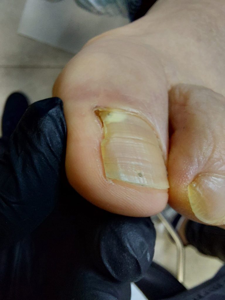 Zwężony i zdeformowany paznokieć palucha po wielokrotnym klinowym wycięciu płytki paznokciowej.
